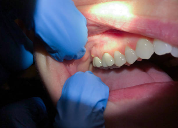 Best Emergency Wisdom Teeth Removal in Cottage Lake, WA
